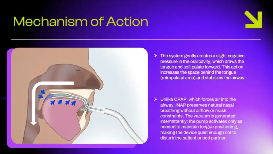 A multicenter, first-night cross-over study demonstrating a 52% responder rate and sustained 28-day benefit in moderate-to-severe OSA